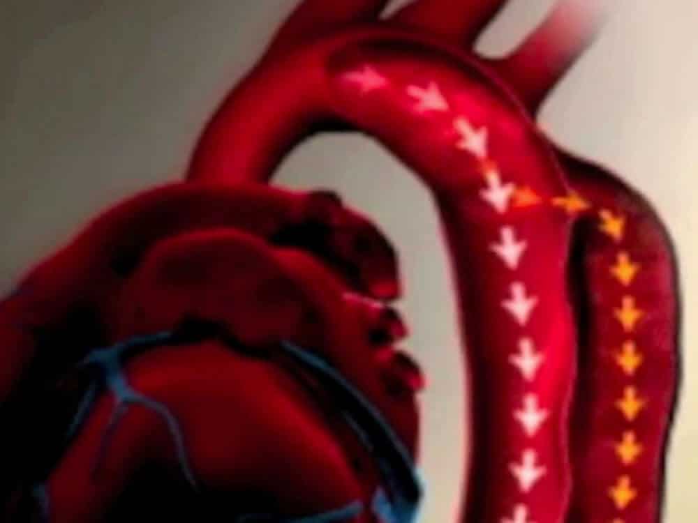 dissecções de aorta