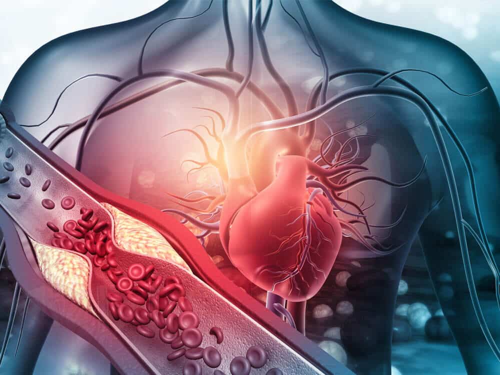 prevencao doencas arteriais-perifericas