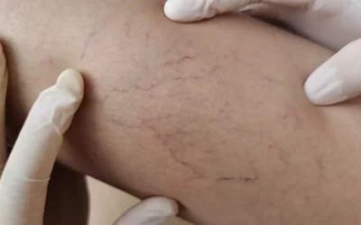 Quer secar vasinhos? Veja como funciona o tratamento e tire suas dúvidas