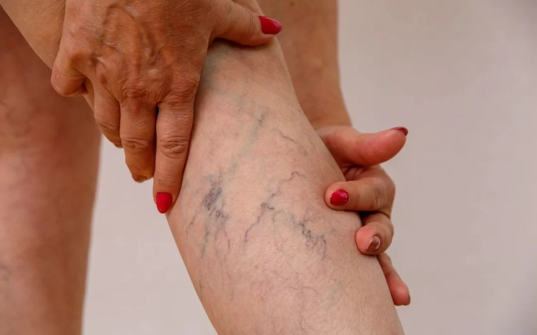 Entenda o que é a insuficiência venosa crônica e como funciona o tratamento