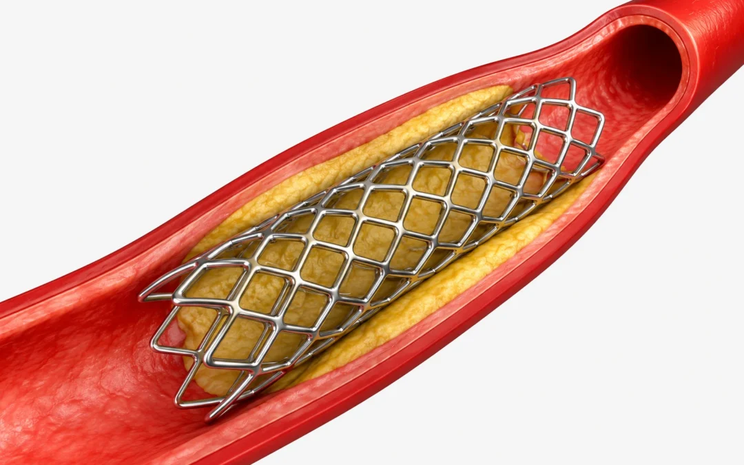 Endoprótese vascular: uma alternativa minimamente invasiva à cirurgia aberta