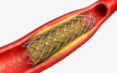 Endoprótese vascular: uma alternativa minimamente invasiva à cirurgia aberta