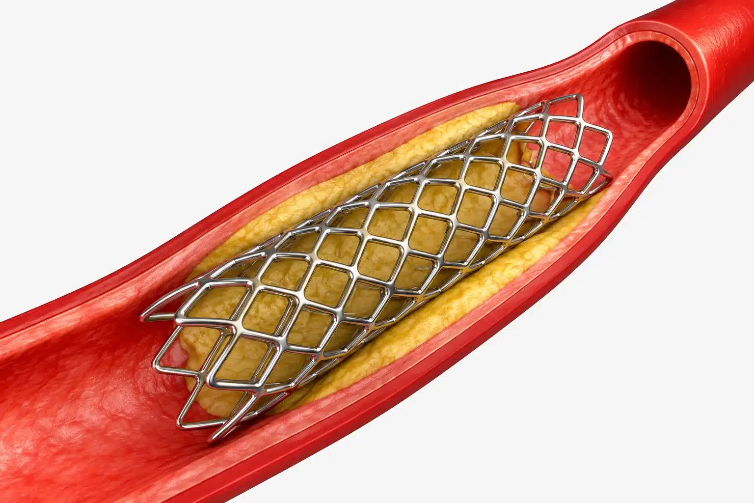 Endoprótese vascular